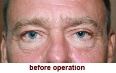 plastic-surgery-blepharoplasty